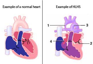 An illustration of hypoplastic left heart syndrome.